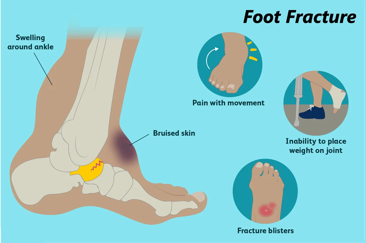 Fractures Treatment